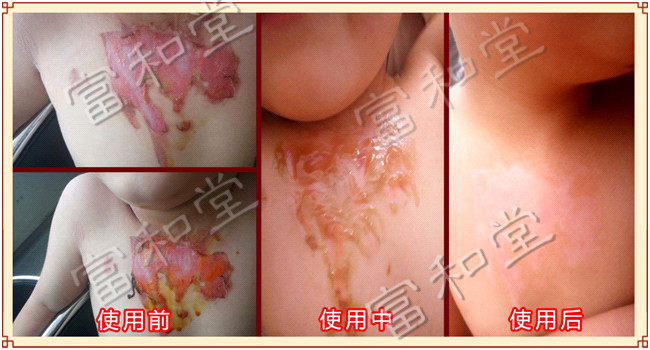 【富和堂案例】5歲男孩胸部二度燙傷使用徐氏燒燙傷保健膏后愈合 【富和堂案例】5歲男孩胸部二度燙傷使用徐氏燒燙傷保健膏后愈合